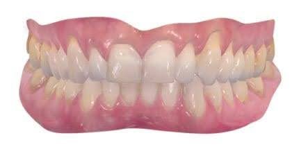 iTero intraoral scanner Impressionless Dentistry 1