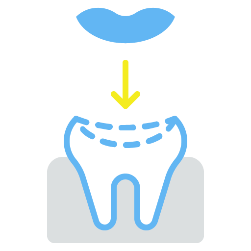 Tooth-Colored Fillings